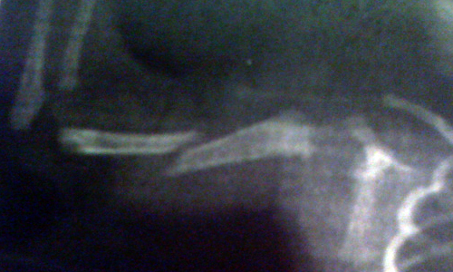 Lucas' 'not so' Humerus